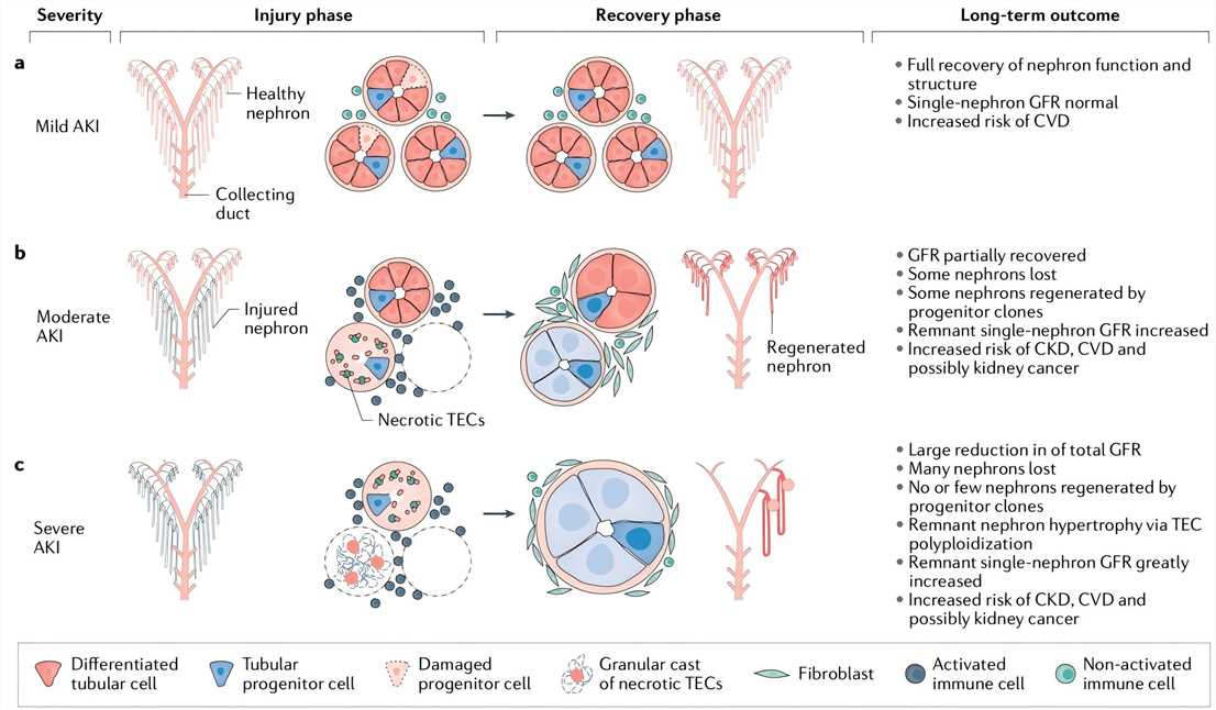 Fig.2 Pathophysiology of acute kidney injury. (Kellum, et al., 2021)