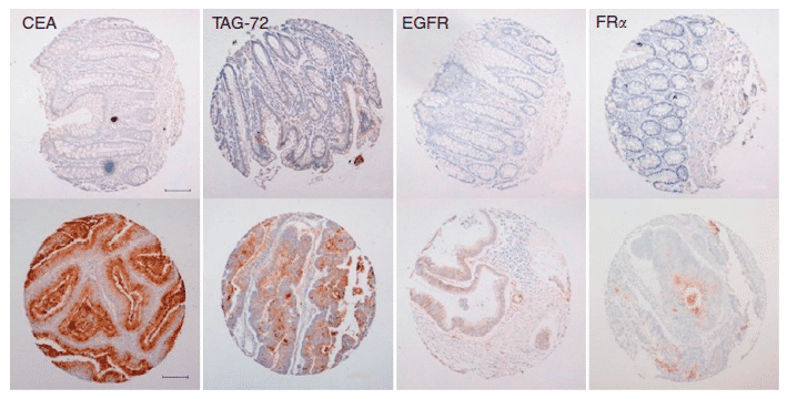 Representative tissue microarray cores of normal colorectal tissue (top row) and colorectal tumours (bottom row) showing immunoreactivity as labelled.