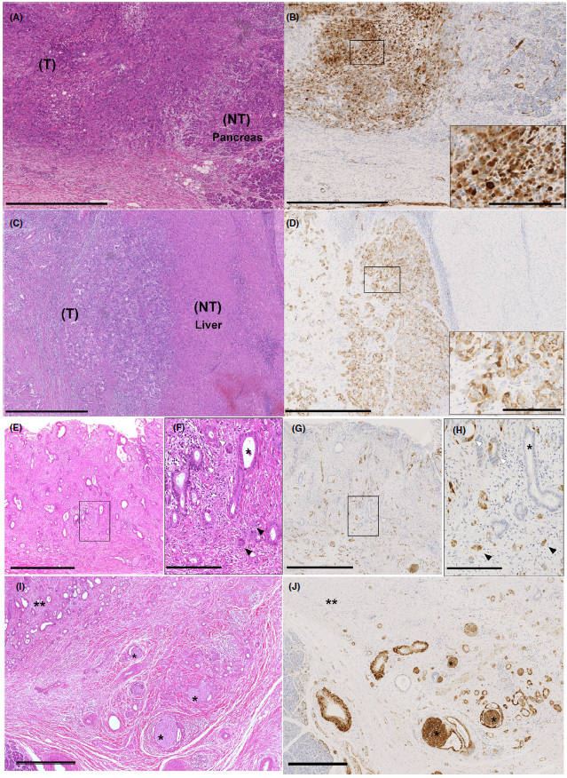 Microphotographs of Immunohistochemical expression of gamma‐synuclein (SNCG) in surgically resected specimens.