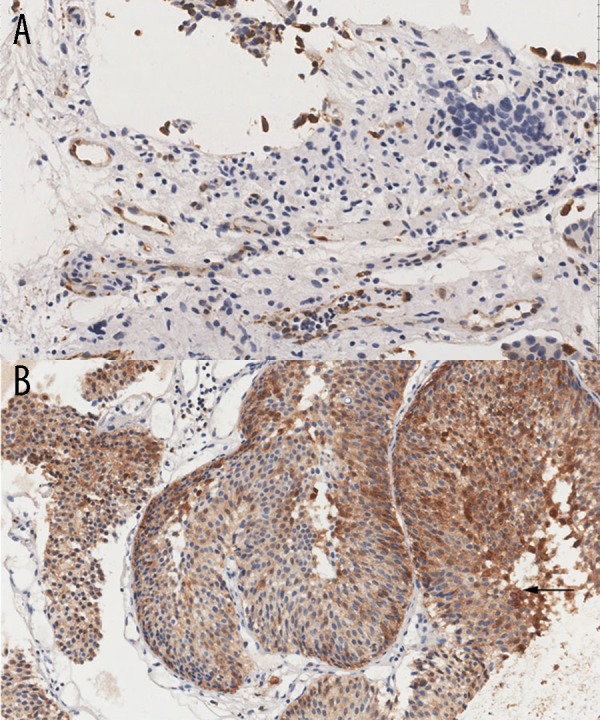 Immunohistochemical staining for γ-synuclein in human bladder cancer tissues.
