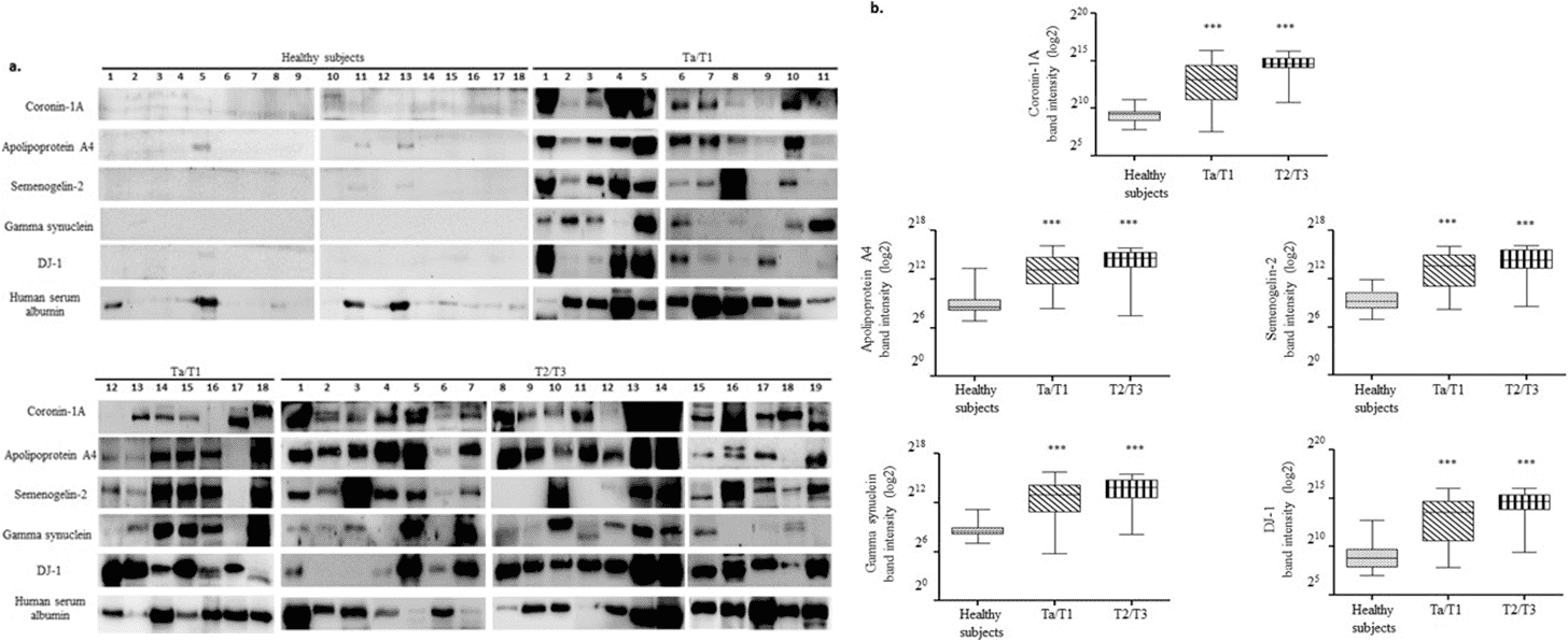 The results of Western blot analysis of urine samples from healthy subjects and bladder carcinoma (BCa) patients.