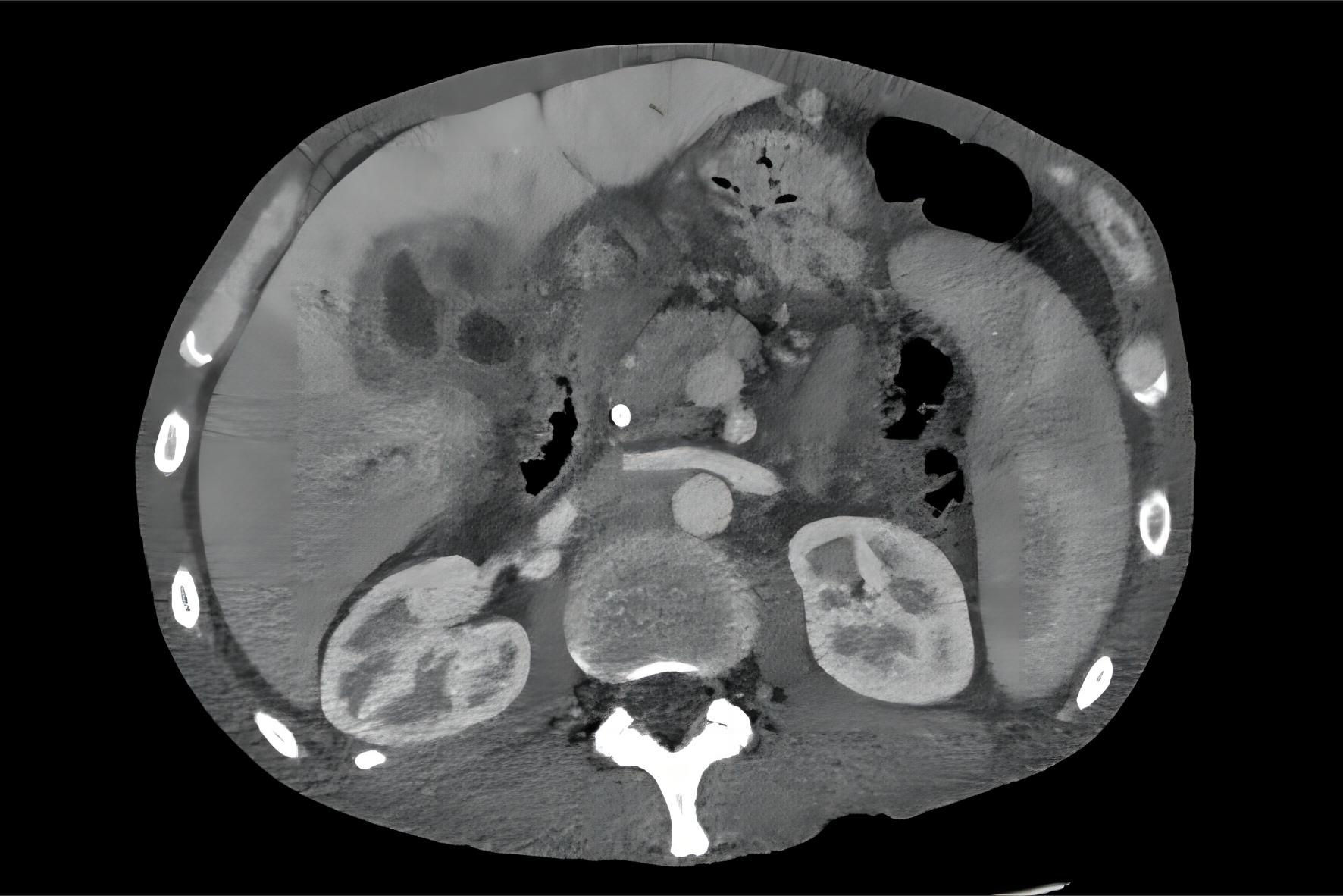 Fig.2 Liver cancer. (From English Wikipedia: By Samir, https://commons.wikimedia.org/wiki/File:CT_cholangioca.jpg)