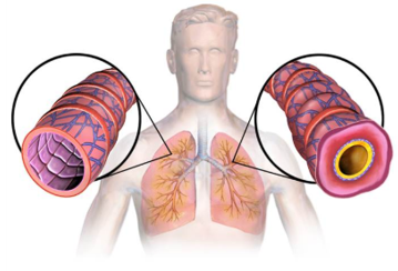 Biomarker and Antibody Development for Asthma