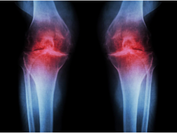 Biomarker and Antibody Development for Osteoarthritis