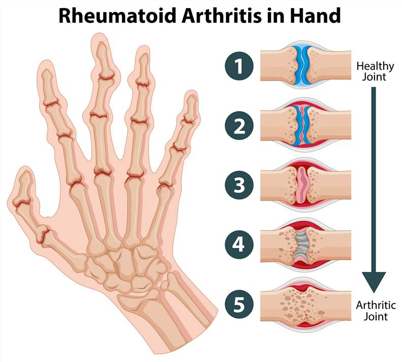 Rheumatoid arthritis.