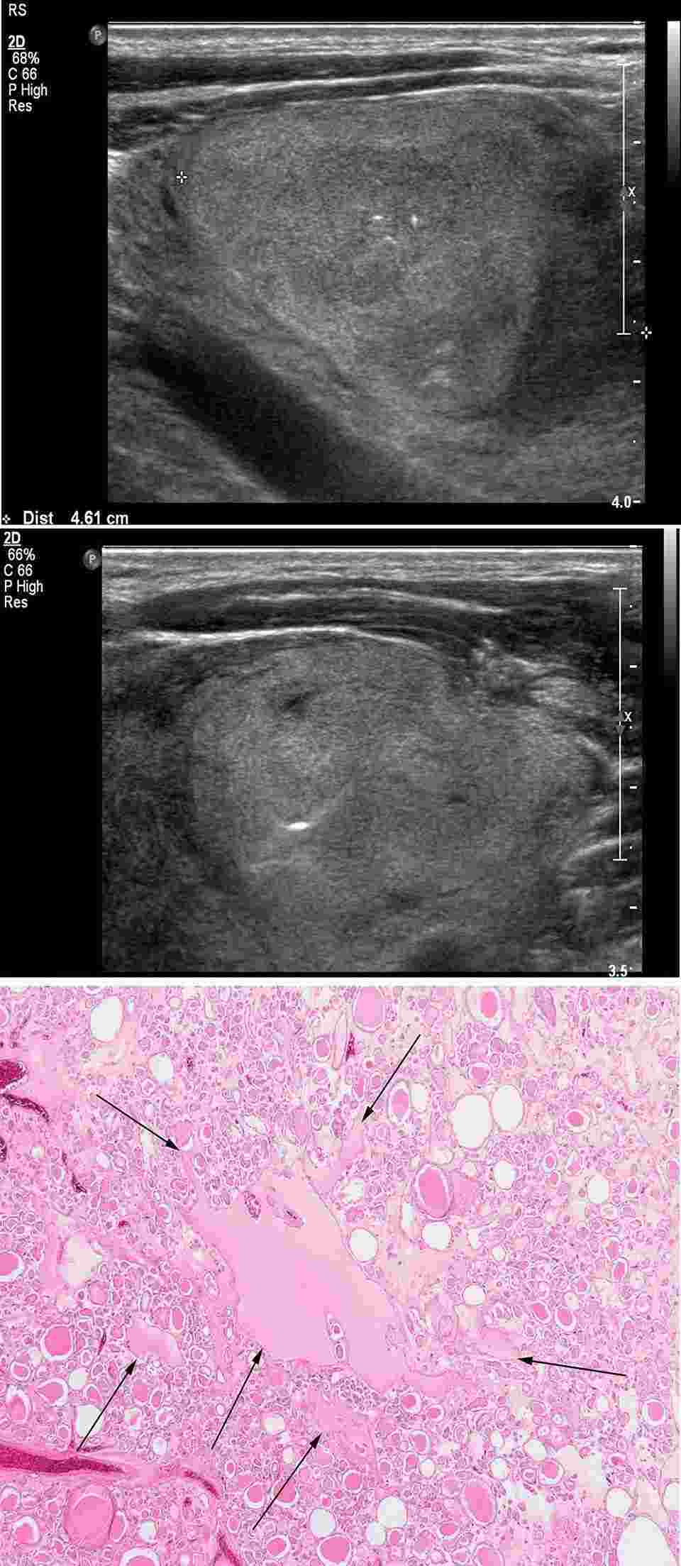 Images from a representative follicular adenoma case.