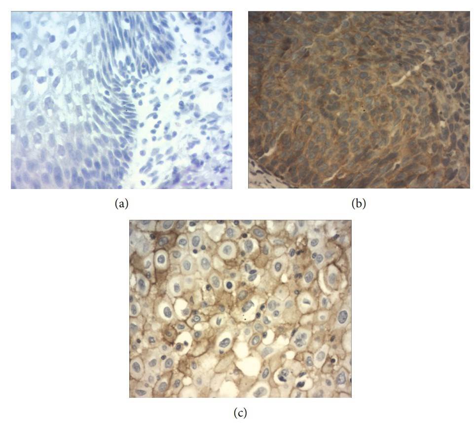 Microphotographs demonstrating expression of B7-H4 in cervical tissues. (a) Negative B7-H4 staining in chronic cervicitis, (b) positive B7-H4 staining in cervical intraepithelial neoplasia-3, and (c) positive B7-H4 staining in squamous cell carcinoma of the cervix.
