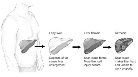 Differrent stages of liver damage.