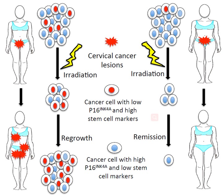Fig.2 Low P16INK4A expression associated with high expression of cancer stem cell markers predicts poor prognosis. (Fu, et al., 2018)