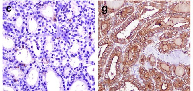 Microphotograph demonstrating the expression of HBME-1 in follicular adenoma and follicular variant of papillary carcinoma (Left: absence of immunoexpression of HBME-1; Right: membranous and cytoplasmatic immunoexpression of HBME-1).