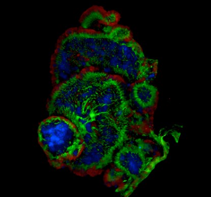 A picture of tumor cells 8. (Creative Biolabs AI)