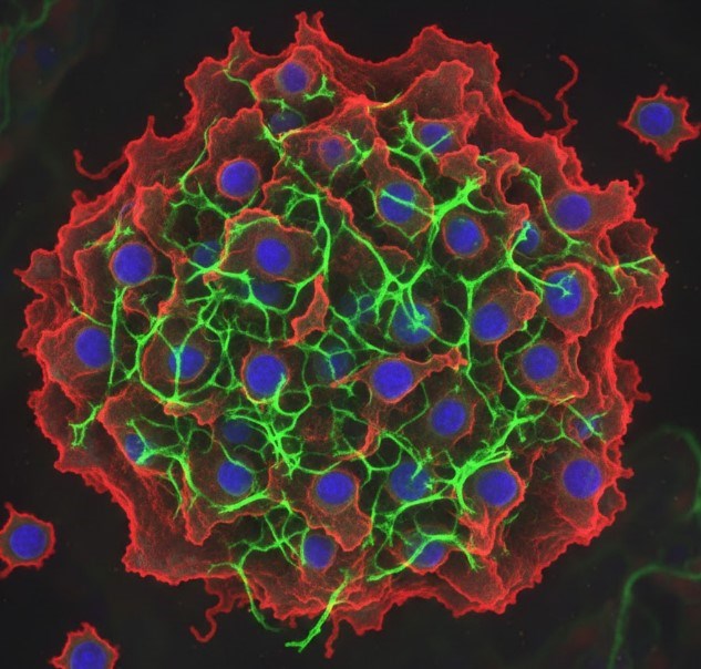 A picture of tumor cells 10. (Creative Biolabs AI)