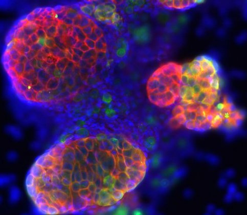 A picture of tumor cells 6. (Creative Biolabs AI)