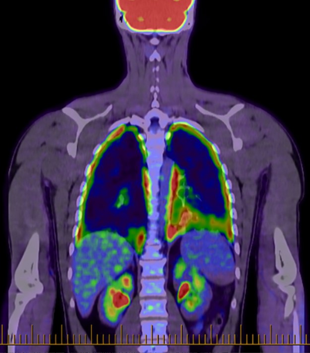Fig.1 Diffuse pleural FDG uptake was seen on the whole-body PET scan. (OA Literature)