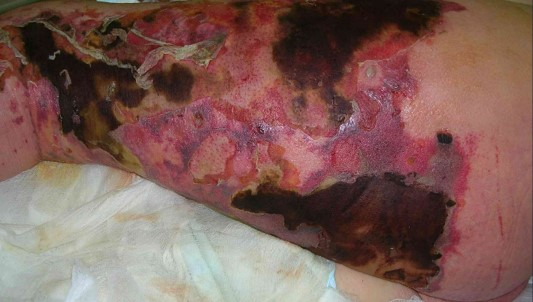 Picture of Skin and Soft Tissue Infection Model (Creative Biolabs Authorized)