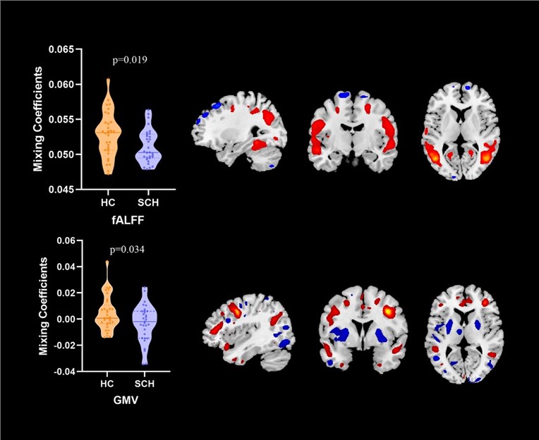 Fig.1 PNS-related gray matter deficits within the cerebellar-thalamic-cortical circuit in schizophrenia. (OA Literature)