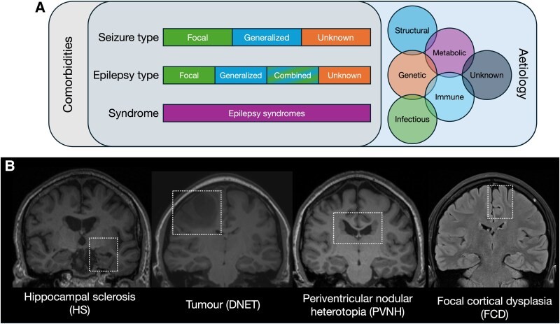 Fig.1 Challenge of heterogeneity in epilepsy. (OA Literature)