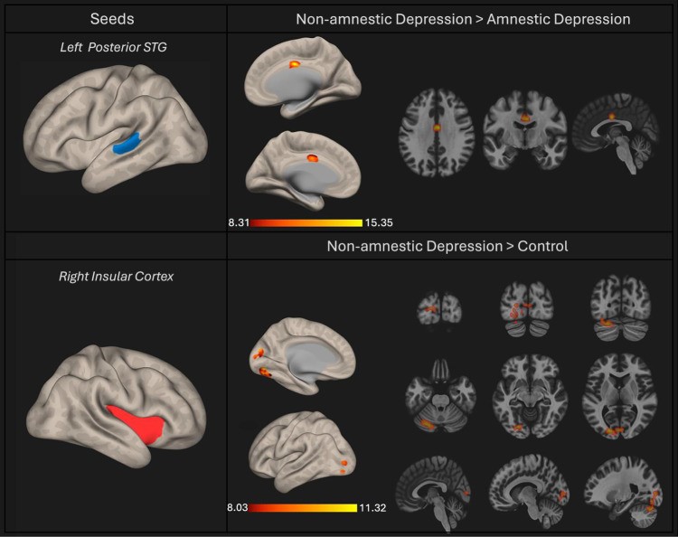 Fig.1 Compared to individuals with amnestic depression, those in the non-amnestic group exhibited heightened connectivity between the left posterior STG and the anterior cingulate. (OA Literature)