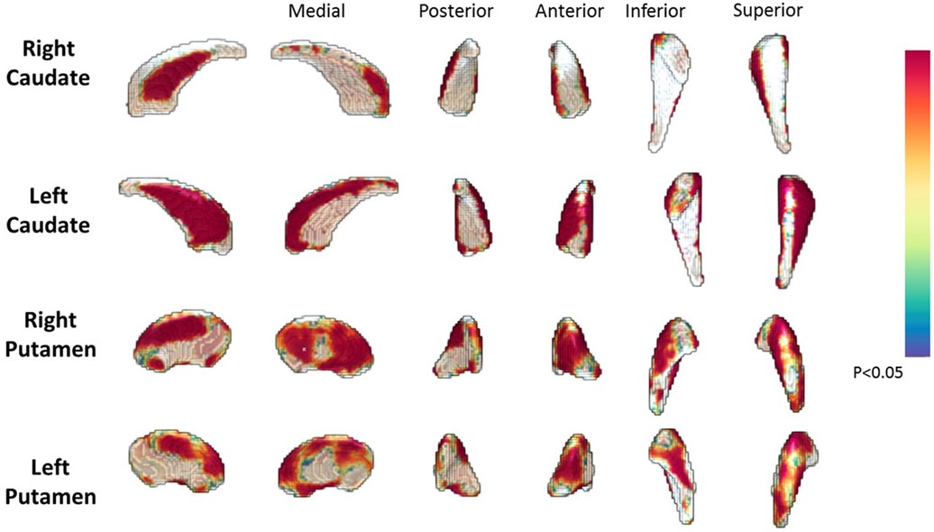 Fig.1 Vertex-wise shape of prodromal HD and healthy controls. (OA Literature)