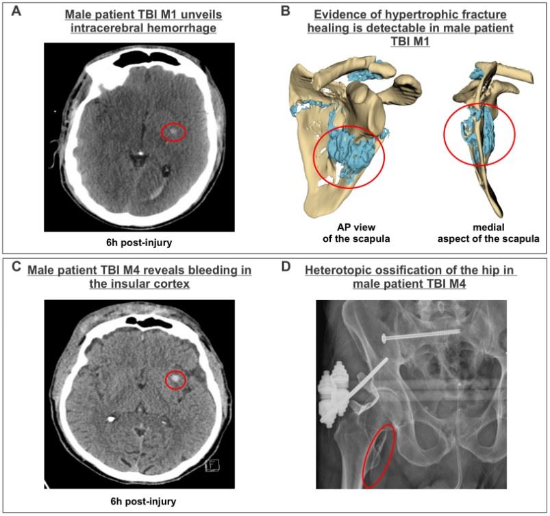 Fig.1 Acute intracranial hemorrhage in specific brain regions (centrum semiovale and insular cortex) is linked to secondary musculoskeletal complications, such as hypertrophic healing and heterotopic ossification. (OA Literature)