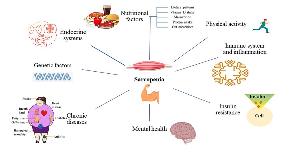 Graphical representation of sarcopenia. (OA Literature)