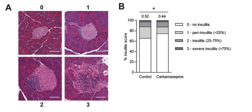 Fig.1 A picture showing that Carbamazepine treatment reduces insulitis in NOD mice. (OA Literature)