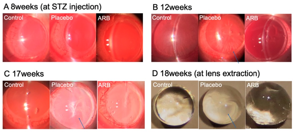 Fig.1 A picture of cataract Progression in STZ Rats. (OA Literature)
