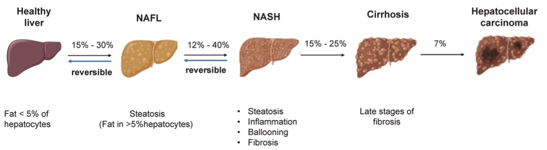 Fig.1 A picture showing the pathogenesis of NAFLD. (OA Literature)