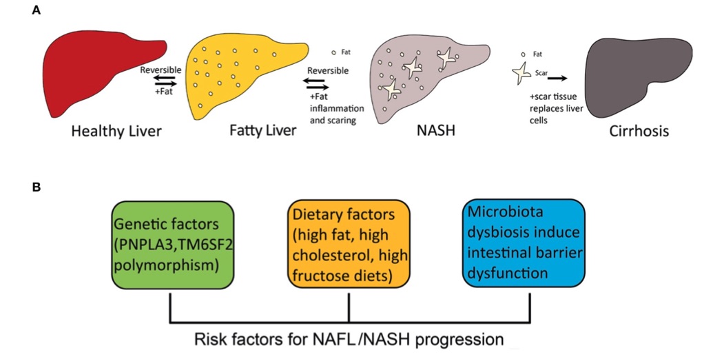 Fig.1 The development of fatty liver disease and the factors contributing to the progression from NAFL to NASH. (OA Literature)