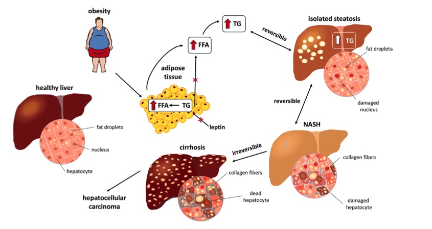 Fig.1 A picture showing the stages of NASH. (OA Literature)