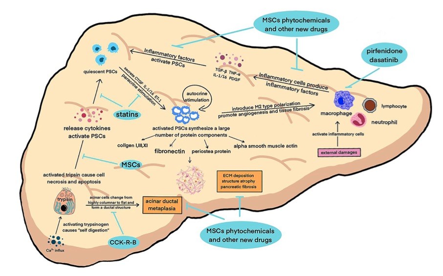 A picture of pathogenic factors that damage the pancreas. (OA Literature)