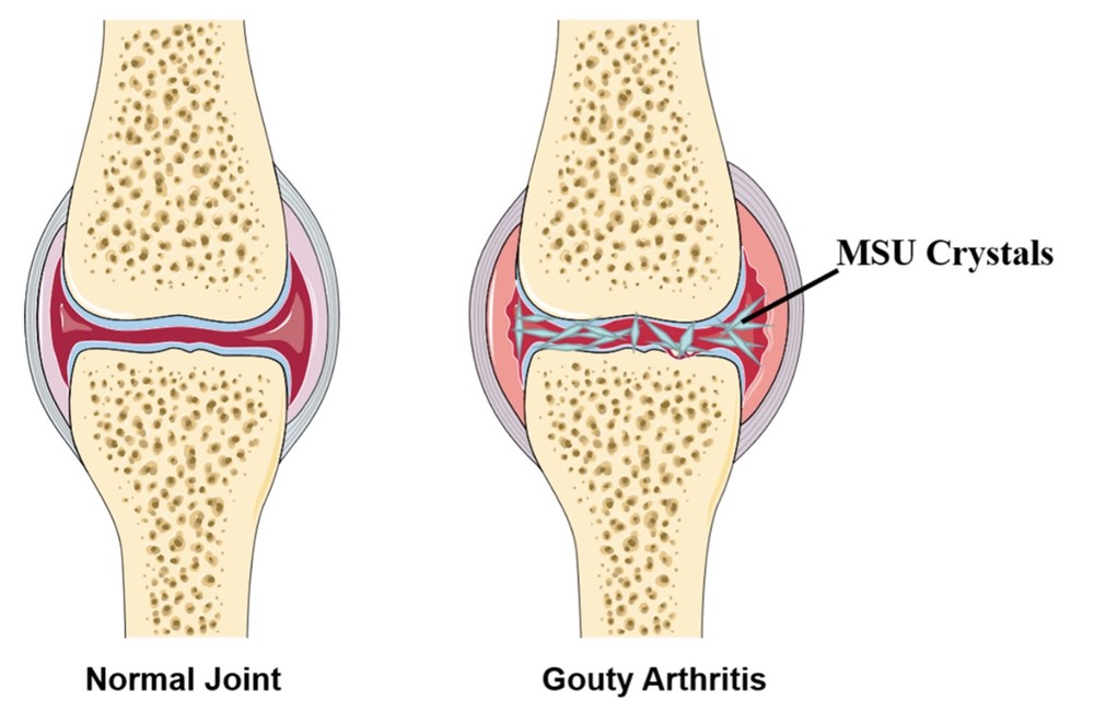 Overview of a normal joint and Gouty Arthritis (GA) for comparison. (OA Literature)