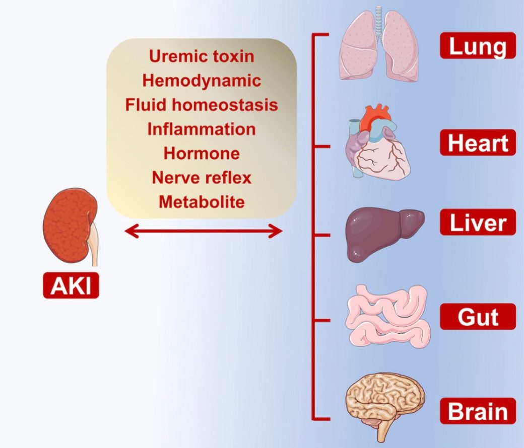 An overview of inter-organ communication during acute kidney injury. (OA Literature)
