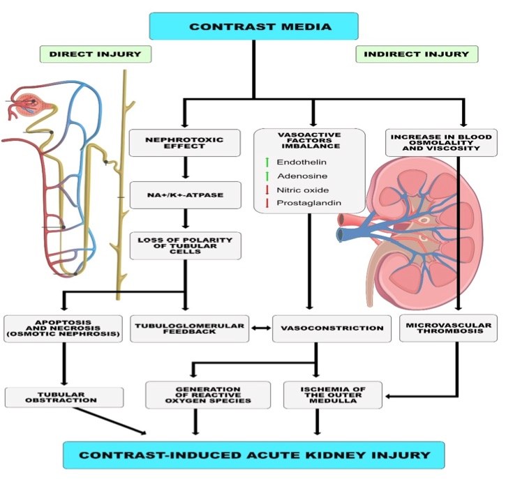 A picture showing the mechanism of contrast-induced acute kidney injury. (OA Literature)