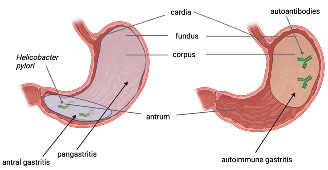 Fig.1 A picture of different types of gastric precancerous conditions in the stomach. (OA Literature)