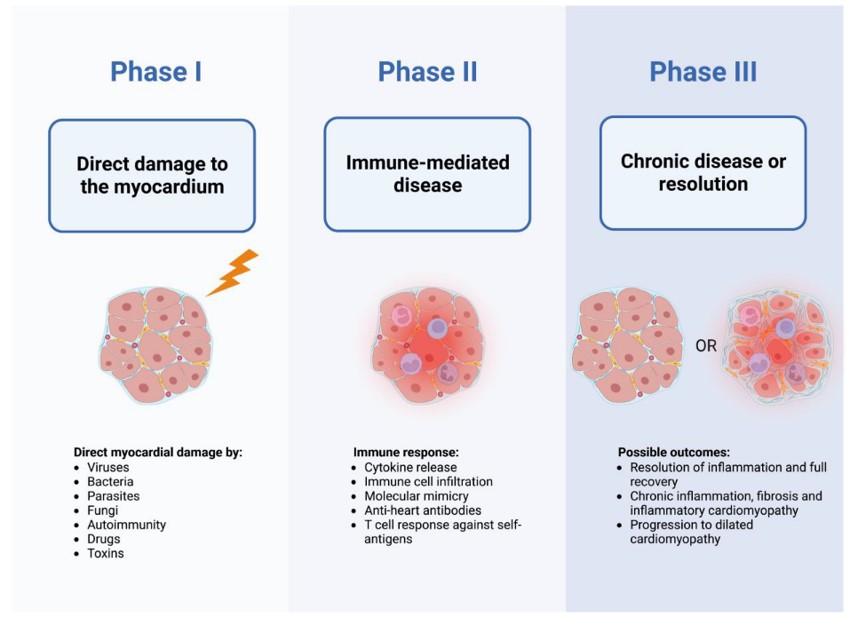 Triphasic model of myocarditis pathogenetic mechanisms based on clinical observations and experimental data. (OA Literature)