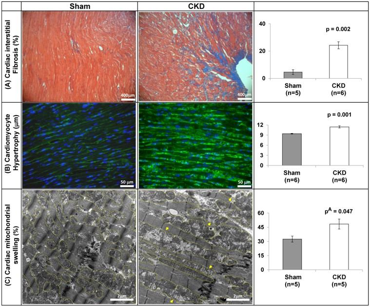 CKD setting enhances cardiac fibrosis, cardiomyocyte' hypertrophy and cardiac mitochondrial swelling. (OA Literature)