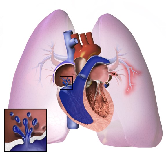 An illustration depicting pulmonary hypertension.