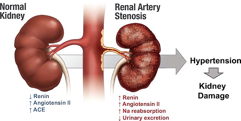 Key factors of RAS-induced renovascular hypertension and kidney damage. (OA Literature)