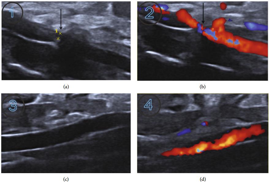 Echocardiogram results of the abdominal aortic contraction-induced HF model in rats. (OA Literature)