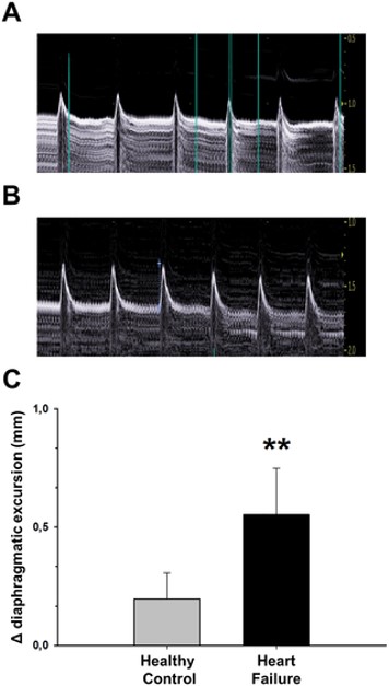The ISO-induced HF model significantly modifies echocardiographically-measured diaphragm function. (OA Literature)