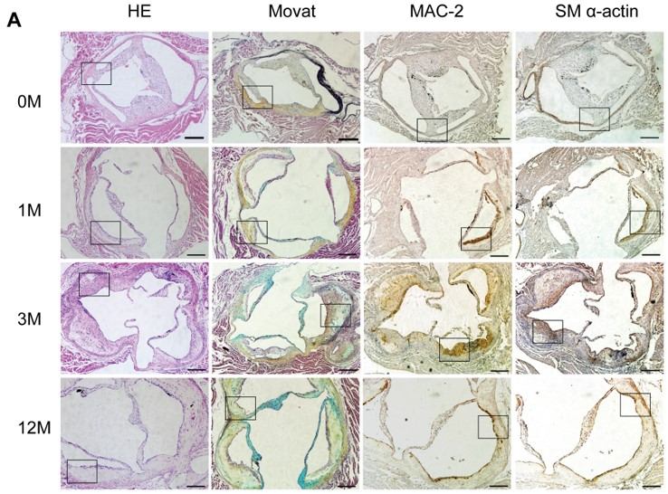 Histological examination of atherosclerotic lesion development in the aortic sinus of LDLR-/- mice. (OA Literature)