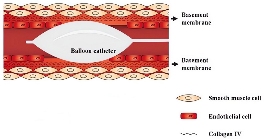 Schematic representation of the vascular injury of endothelium denudation. (OA Literature)
