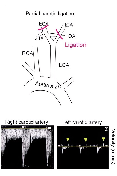 The partial carotid ligation (PCL) of the LCA for inducing disturbed hemodynamics. (OA Literature)