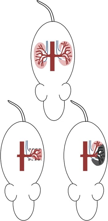 Diagrammatic presentation of 5/6 Nx operation. (OA Literature)
