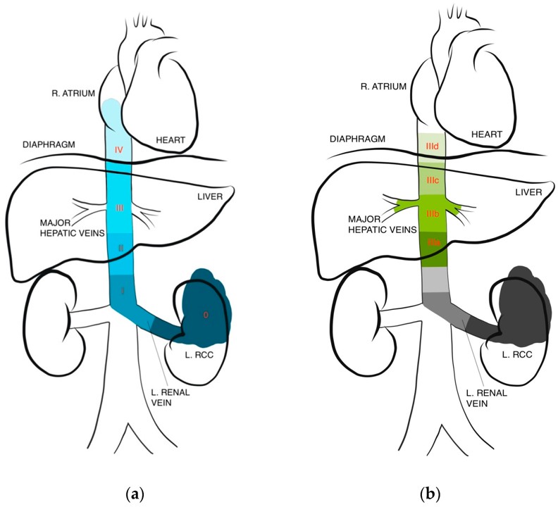 Classification of lVC level thrombus. (OA Literature)