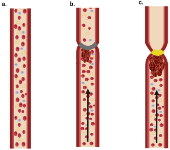 A simplified diagram of stasis and stenosis obtained through the tightening of the blood vessel. (OA Literature)