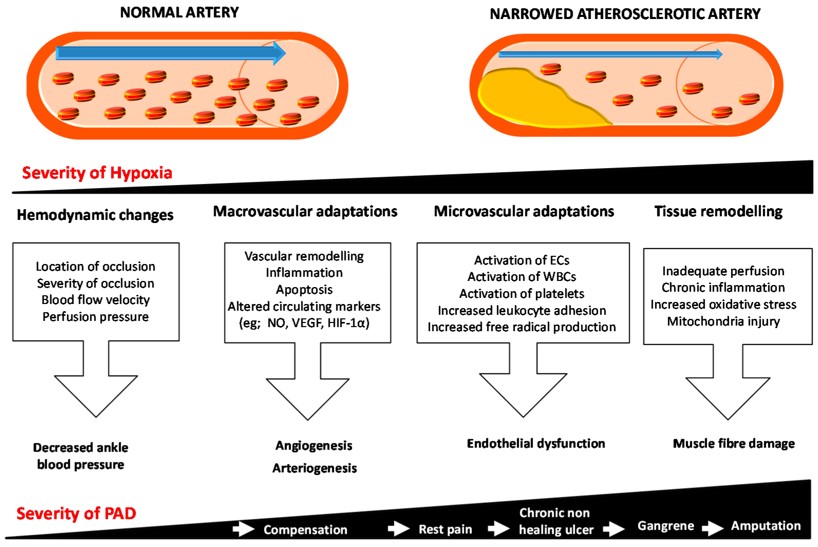 Schematic representation of the response to ischemia in PAD. (OA Literature)