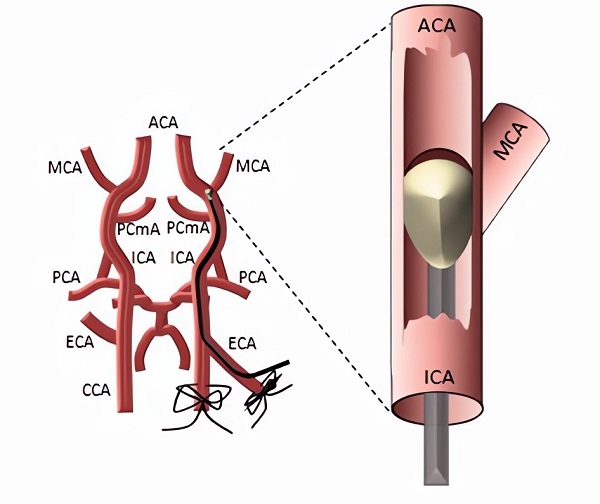 Illustration of the tMCAO model of ischemic stroke in rodents. (OA Literature)
