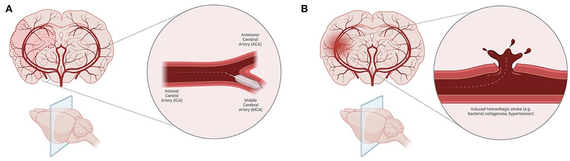 MCAO model of ischemic stroke and induced hemorrhagic stroke animal model (e.g., bacterial collagenase, induced hypertension). (OA Literature)
